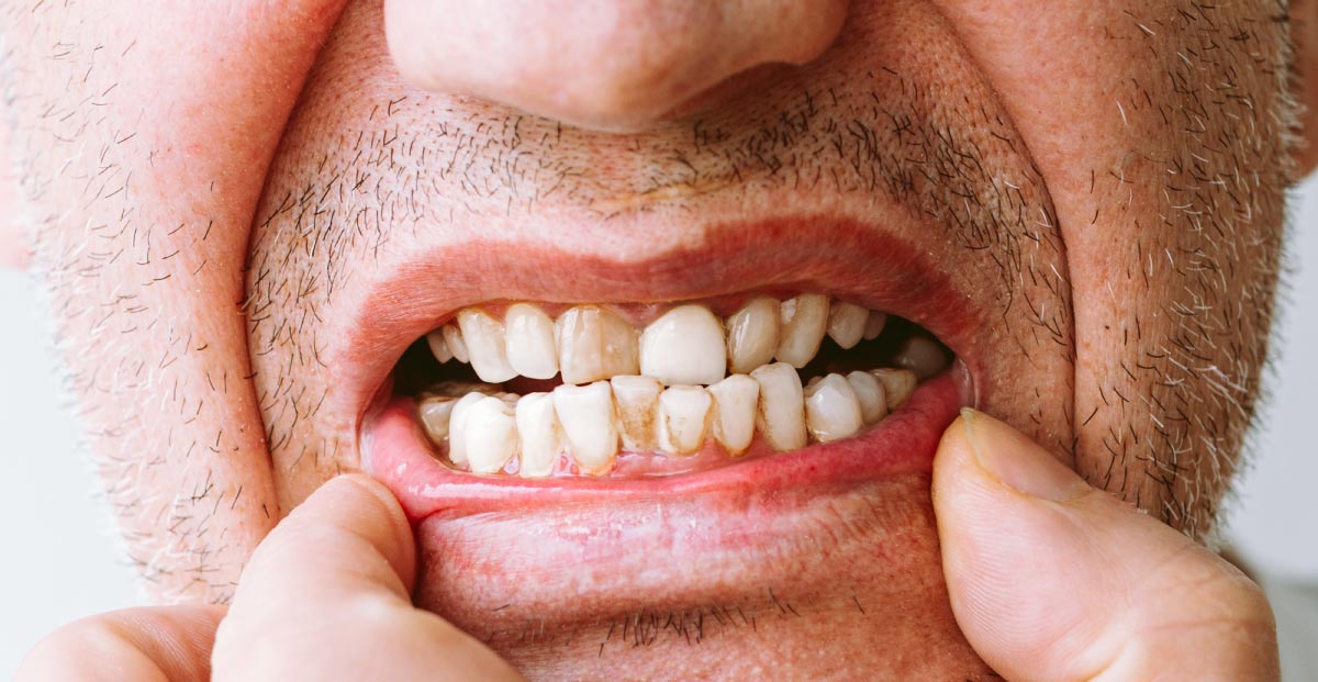 Bruine tanden