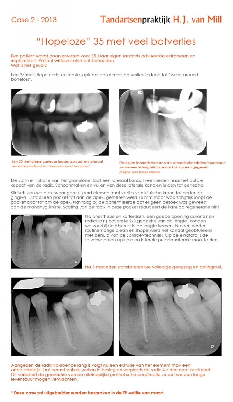 Casus endodontie, februari 2013: Hopeloze 35 met veel botverlies