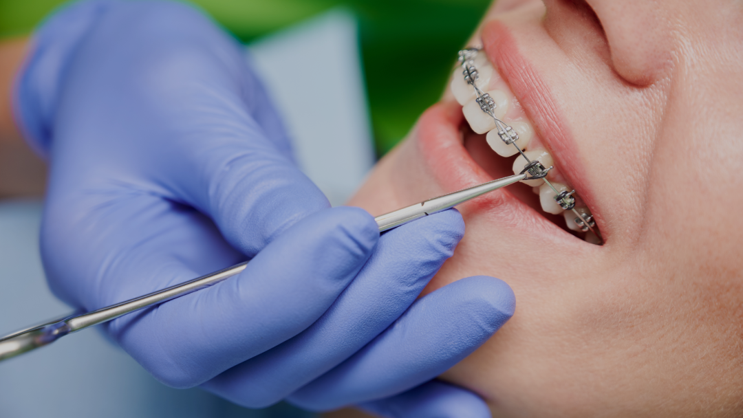 orthodontische behandeling