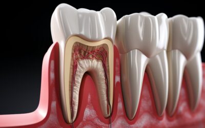 Het uitstellen van een wortelkanaalbehandeling brengt grote risico’s met zich mee